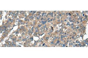 Immunohistochemistry of paraffin-embedded Human liver cancer tissue using BCL2L2 Polyclonal Antibody at dilution of 1:40(x200)