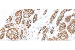 Immunohistochemistry of paraffin-embedded Human esophagus cancer tissue using FOXG1 Polyclonal Antibody at dilution of 1:60(x200)