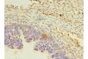Immunohistochemistry of paraffin-embedded human ovarian cancer using ABIN7165486 at dilution of 1:100