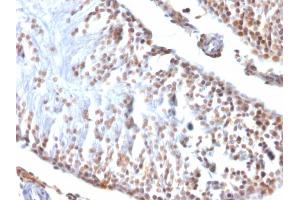 Image no. 4 for anti-Wilms Tumor 1 (WT1) (AA 1-181) antibody (ABIN6940900)