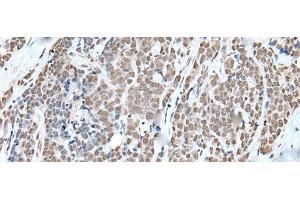 Immunohistochemistry of paraffin-embedded Human thyroid cancer tissue using WTAP Polyclonal Antibody at dilution of 1:35(x200)