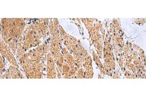 Immunohistochemistry of paraffin-embedded Human esophagus cancer tissue using SLC4A3 Polyclonal Antibody at dilution of 1:35(x200)