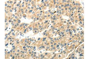 The image on the left is immunohistochemistry of paraffin-embedded Human liver cancer tissue using ABIN7193040(WDR36 Antibody) at dilution 1/35, on the right is treated with synthetic peptide.
