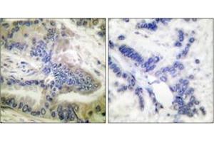 Immunohistochemistry analysis of paraffin-embedded human colon carcinoma, using Caspase 6 (Phospho-Ser257) Antibody.
