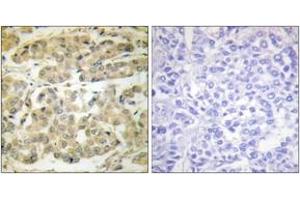 Immunohistochemistry analysis of paraffin-embedded human breast carcinoma, using 14-3-3 zeta (Phospho-Ser58) Antibody.