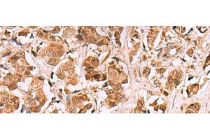 Immunohistochemistry of paraffin-embedded Human breast cancer tissue using RRP8 Polyclonal Antibody at dilution of 1:80(x200)