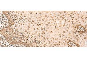 Immunohistochemistry of paraffin-embedded Human esophagus cancer tissue using BAP1 Polyclonal Antibody at dilution of 1:35(x200)