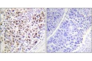 Immunohistochemistry analysis of paraffin-embedded human liver carcinoma, using AurB (Phospho-Thr232) Antibody.