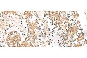 Immunohistochemistry of paraffin-embedded Human lung cancer tissue using HNF1A Polyclonal Antibody at dilution of 1:25(x200)