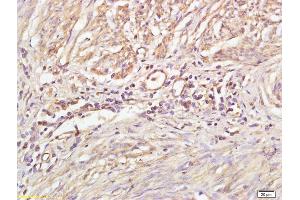 Formalin-fixed and paraffin embedded human cervical carcinoma labeled with Anti-Phospho-PKC gamma (Thr514) Polyclonal Antibody, Unconjugated (ABIN703285) at 1:200 followed by conjugation to the secondary antibody