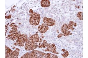 IHC-P Image Immunohistochemical analysis of paraffin-embedded SW480 Xenograft, using S100A11, antibody at 1:500 dilution.