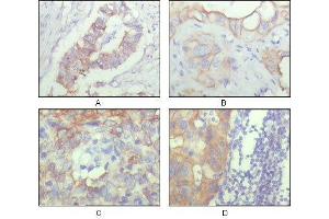 Figure 1: Immunohistochemical analysis of paraffin-embedded human ovary carcinoma (A), kidney carcinoma (B), lung carcinoma (C) and breast carcinoma (D), showing cytoplasmic and membrane localization with DAB staining using ALCAM mouse mAb.