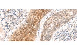 Immunohistochemistry of paraffin-embedded Human esophagus cancer tissue using GHDC Polyclonal Antibody at dilution of 1:90(x200)
