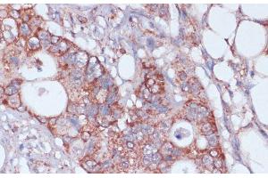Immunohistochemistry of paraffin-embedded Human colon carcinoma using MRPL23 Polyclonal Antibody at dilution of 1:100 (40x lens).