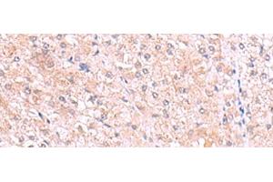 Immunohistochemistry of paraffin-embedded Human liver cancer tissue using PISD Polyclonal Antibody at dilution of 1:80(x200)