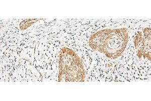 Immunohistochemistry of paraffin-embedded Human esophagus cancer tissue using HNF1A Polyclonal Antibody at dilution of 1:25(x200)