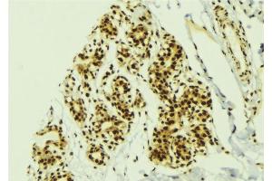 ABIN6277754 at 1/100 staining Human breast cancer tissue by IHC-P.