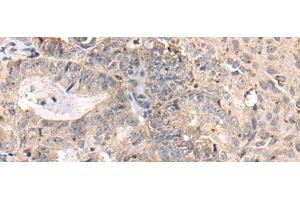 Immunohistochemistry of paraffin-embedded Human ovarian cancer tissue using MEDAG Polyclonal Antibody at dilution of 1:75(x200)
