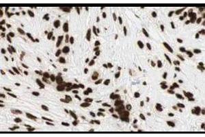 Affinity Purified anti-Gli2 antibody shows strong cytoplasmic and membranous staining of tumor cells in human breast tissue.