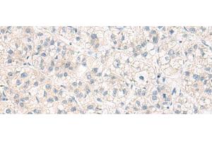Immunohistochemistry of paraffin-embedded Human liver cancer tissue using ANKS6 Polyclonal Antibody at dilution of 1:55(x200)