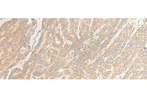 Immunohistochemistry of paraffin-embedded Human liver cancer tissue using WDR6 Polyclonal Antibody at dilution of 1:35(x200)