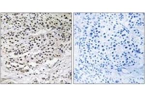 Immunohistochemistry analysis of paraffin-embedded human breast carcinoma tissue, using AZI1 Antibody.