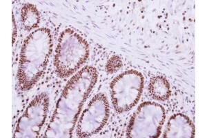 IHC-P Image Immunohistochemical analysis of paraffin-embedded human colon carcinoma, using PABPN1, antibody at 1:250 dilution.