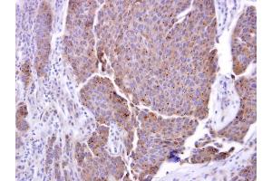 IHC-P Image ADAM17 antibody [C2C3], C-term detects ADAM17 protein at cytosol on human breast carcinoma by immunohistochemical analysis.