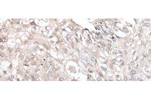 Immunohistochemistry of paraffin-embedded Human lung cancer tissue using VRK3 Polyclonal Antibody at dilution of 1:45(x200)
