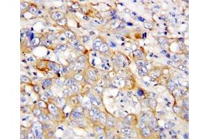 IHC-P: CXCL4 antibody testing of human lung cancer tissue