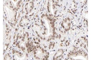 ABIN6279558 at 1/100 staining human Prostate carcinoma tissue sections by IHC-P.