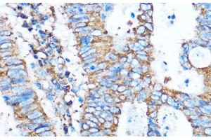 Immunohistochemistry of paraffin-embedded Human colon carcinoma using PIK3CA Polyclonal Antibody at dilution of 1:100 (40x lens).