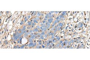 Immunohistochemistry of paraffin-embedded Human thyroid cancer tissue using PLA2G16 Polyclonal Antibody at dilution of 1:40(x200)