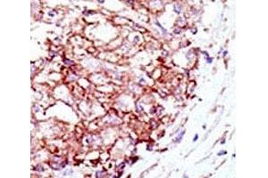 IHC analysis of FFPE human hepatocarcinoma tissue stained with the Mib1 antibody