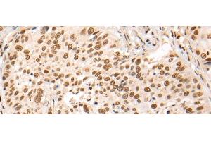 Immunohistochemistry of paraffin-embedded Human lung cancer tissue using HOXA7 Polyclonal Antibody at dilution of 1:70(x200)
