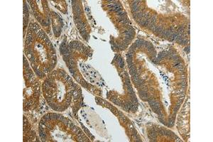 Immunohistochemical analysis of paraffin-embedded Human colon cancer tissue using at dilution 1/70.