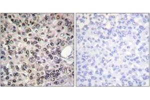Immunohistochemistry analysis of paraffin-embedded human breast carcinoma, using DDX5/DEAD-box Protein 5 (Phospho-Tyr593) Antibody.