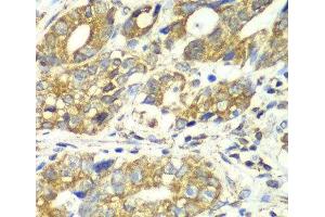 Immunohistochemistry of paraffin-embedded Human gastric cancer using DLST Polyclonal Antibody at dilution of 1:100 (40x lens).