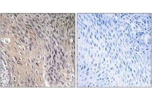 Immunohistochemistry analysis of paraffin-embedded human cervix carcinoma, using ARHGDIA (Phospho-Ser174) Antibody.