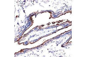Immunohistochemistry of paraffin-embedded human lung using MUC1 Rabbit pAb (ABIN6131522, ABIN6144194, ABIN6144195 and ABIN6213810) at dilution of 1:100 (40x lens).