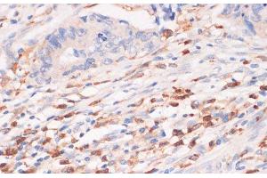 Immunohistochemistry of paraffin-embedded Human colon carcinoma using CYBA Polyclonal Antibody at dilution of 1:100 (40x lens).