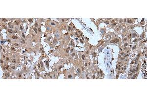 Immunohistochemistry of paraffin-embedded Human esophagus cancer tissue using ZNF787 Polyclonal Antibody at dilution of 1:45(x200)