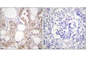 Immunohistochemistry analysis of paraffin-embedded human breast carcinoma, using CDK7 (Phospho-Thr170) Antibody.