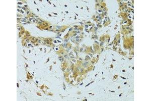 Immunohistochemistry of paraffin-embedded Human breast cancer using METTL13 Polyclonal Antibody at dilution of 1:100 (40x lens).