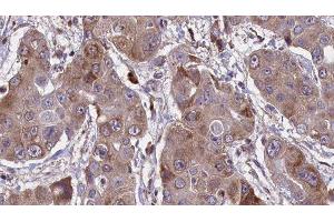 ABIN6276641 at 1/100 staining Human liver cancer tissue by IHC-P.