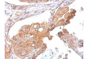 IHC-P Image CCR8 antibody detects CCR8 protein at membrane on human gastric cancer by immunohistochemical analysis.