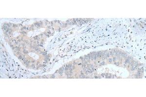 Immunohistochemistry of paraffin-embedded Human colorectal cancer tissue using ITGA8 Polyclonal Antibody at dilution of 1:30(x200)