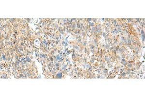 Immunohistochemistry of paraffin-embedded Human cervical cancer tissue using MCCC1 Polyclonal Antibody at dilution of 1:45(x200)