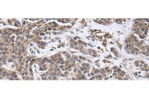 Immunohistochemistry of paraffin-embedded Human colorectal cancer tissue using MBL2 Polyclonal Antibody at dilution of 1:25(x200)