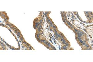 Immunohistochemistry of paraffin-embedded Human thyroid cancer tissue using TMPRSS13 Polyclonal Antibody at dilution 1:40